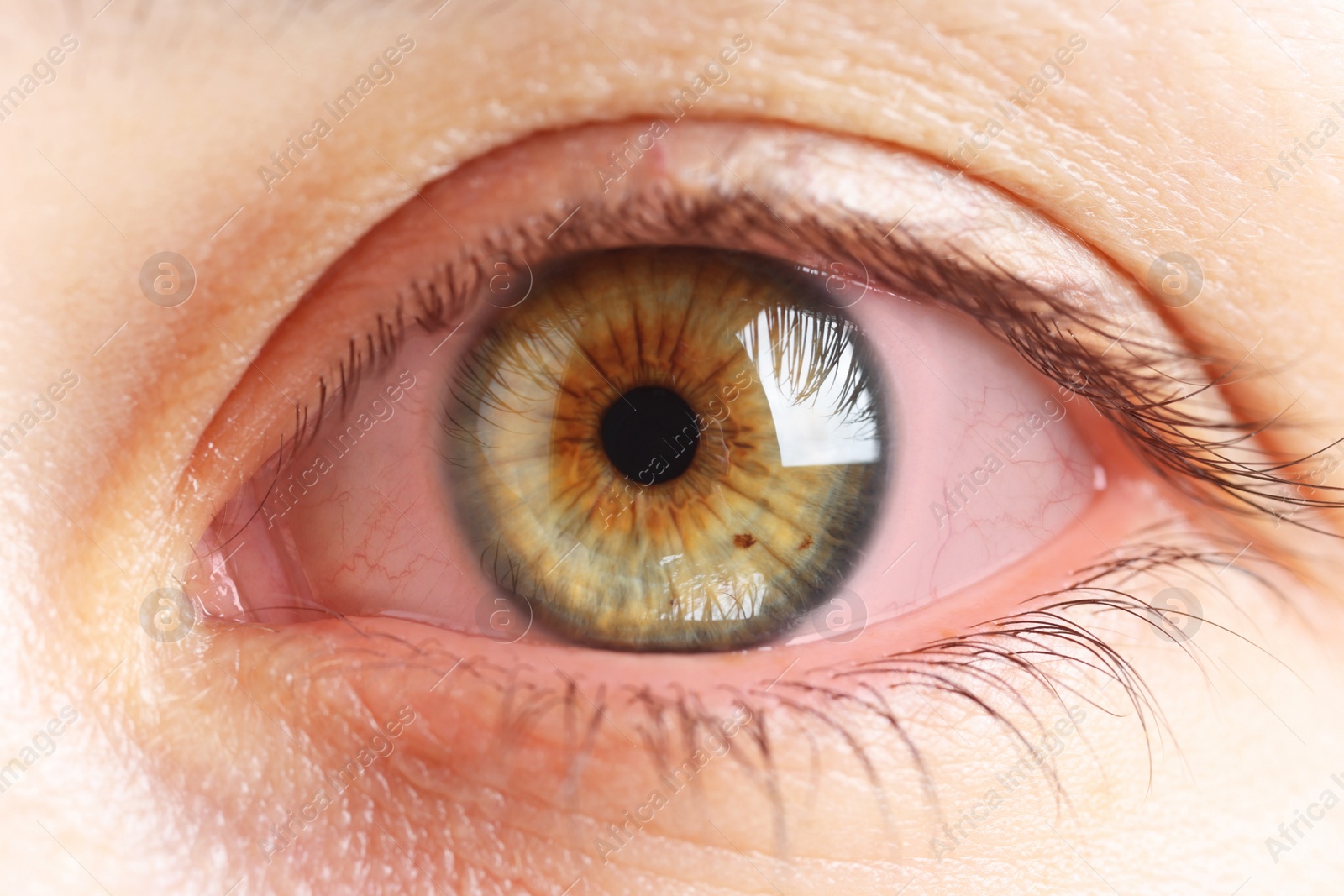 Image of Woman with red eye suffering from conjunctivitis, closeup