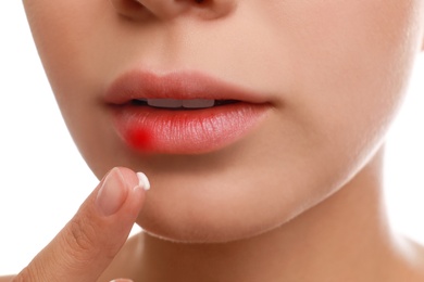 Photo of Young woman with cold sore applying cream onto lips against white background, closeup