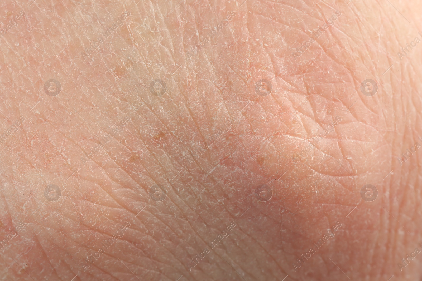 Photo of Texture of dry skin as background, macro view