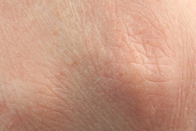 Photo of Texture of dry skin as background, macro view