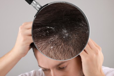 Man suffering from dandruff on light grey background, closeup. View through magnifying glass on hair with flakes