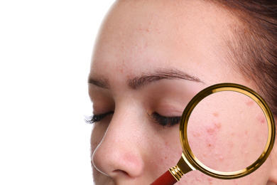Image of Teenage girl with acne problem on white background, closeup. Skin under magnifying glass