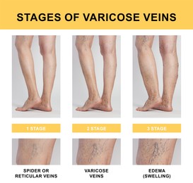 Image of Stages of varicose veins. Photos of woman and zoomed skin area, closeup. Collage showing changes during different phases