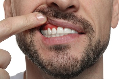 Image of Man showing inflamed gum on white background, closeup