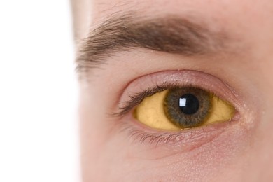 Photo of Man with yellow eyes on white background, closeup. Symptom of hepatitis