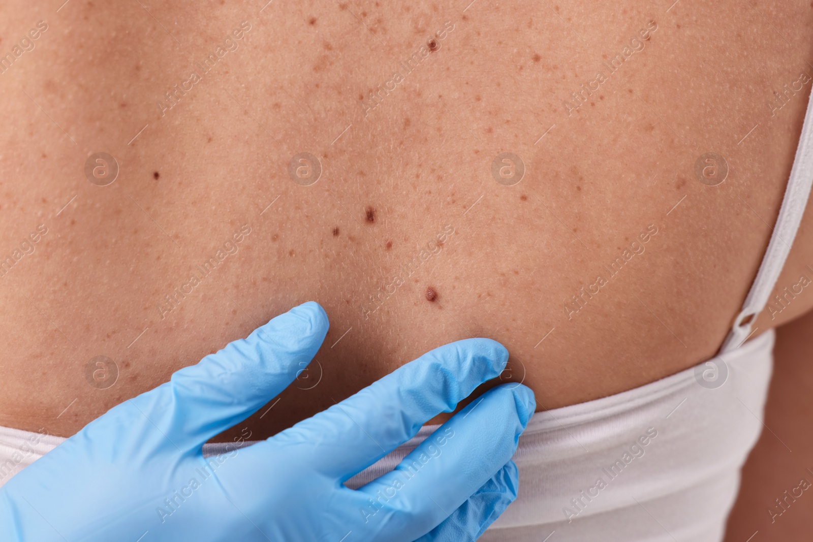 Photo of Dermatologist in rubber glove examining patient's birthmark, closeup view