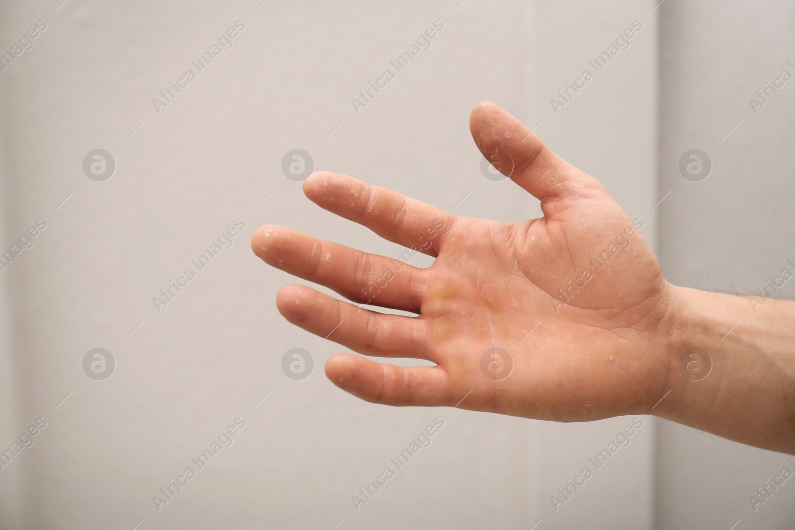 Photo of Man suffering from calluses on hand indoors, closeup