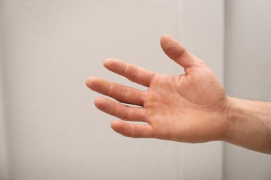 Man suffering from calluses on hand indoors, closeup