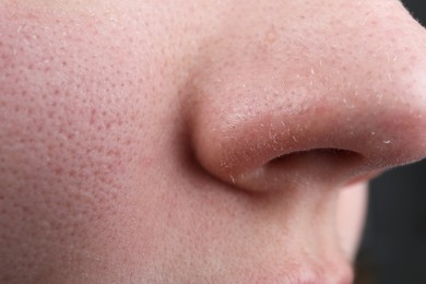 Photo of Woman with dry skin on nose, closeup