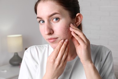 Young woman with acne problem at home