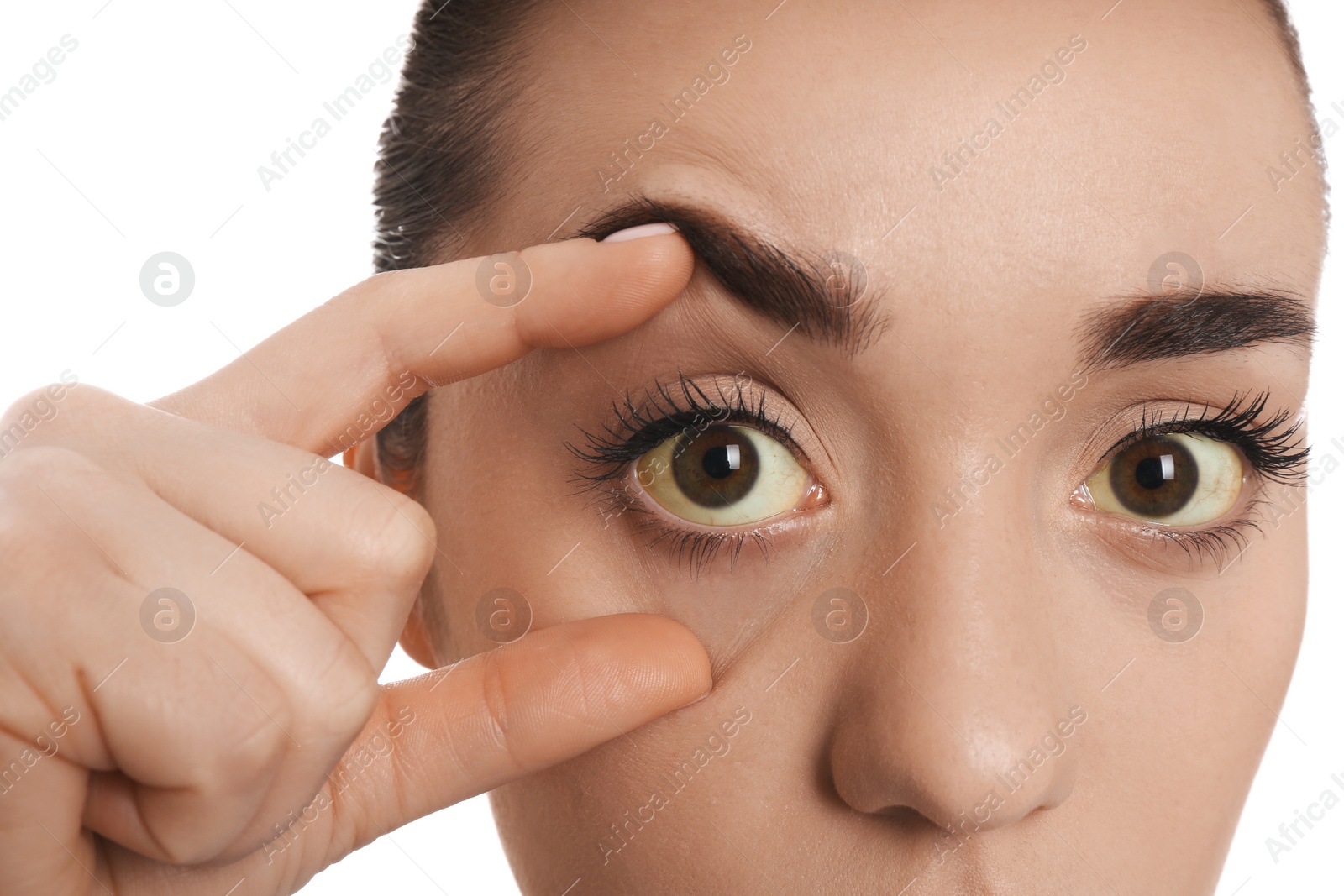 Photo of Woman checking her health condition on white background, closeup. Yellow eyes as symptom of problems with liver