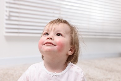 Portrait of little girl with diathesis symptom on cheeks indoors