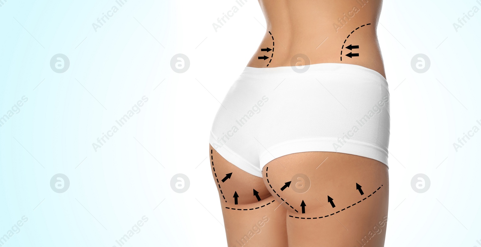 Image of Slim young woman with marks on body for cosmetic surgery operation against light background, closeup. Banner design