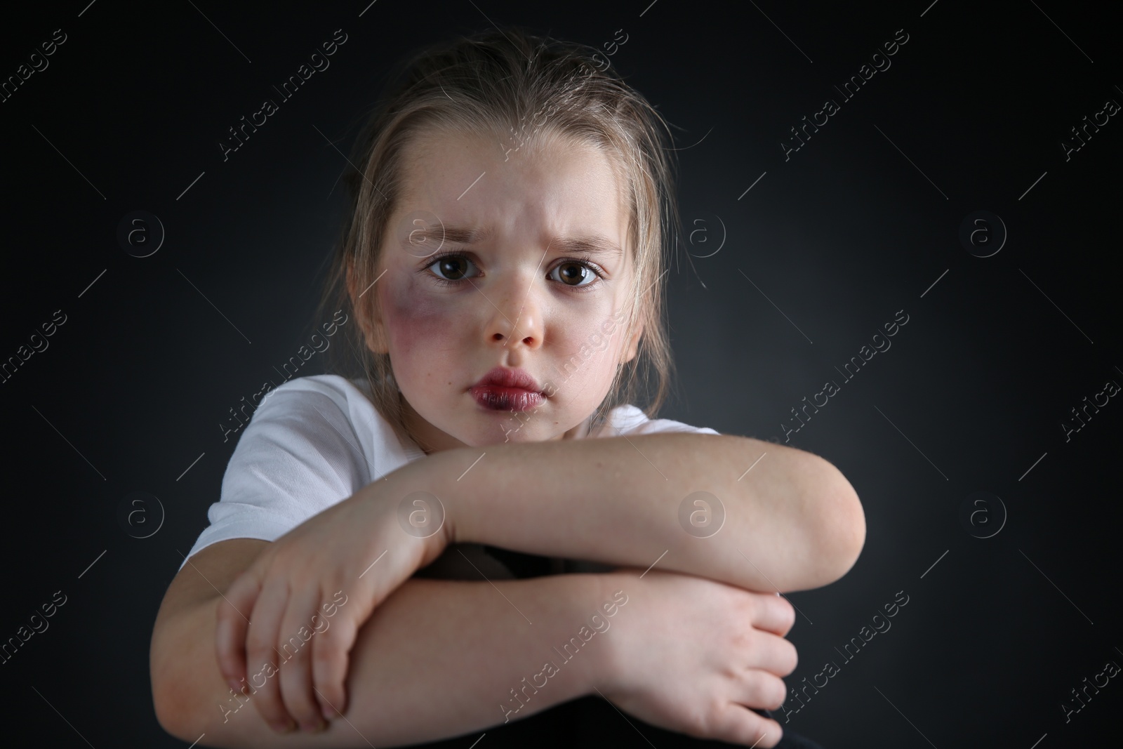 Photo of Little girl with bruises on face against dark background. Domestic violence victim