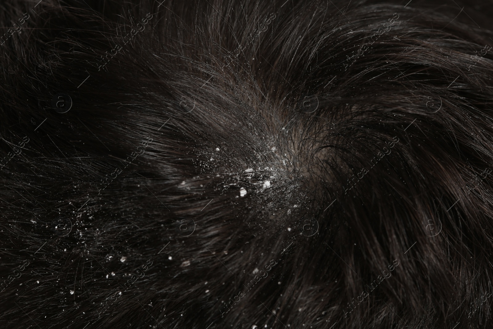 Photo of Man with dandruff in his dark hair, macro view