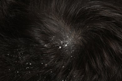 Man with dandruff in his dark hair, macro view