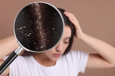 Woman suffering from dandruff on pale brown background. View through magnifying glass on hair with flakes