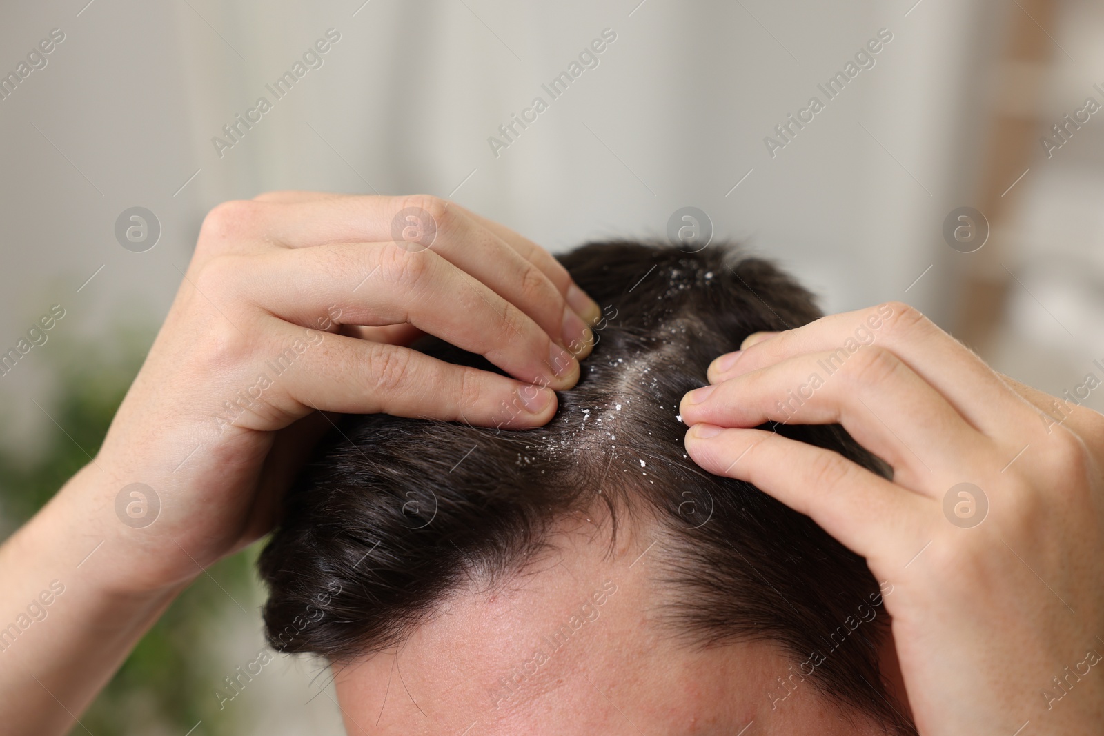 Photo of Man with dandruff in his dark hair on blurred background, closeup