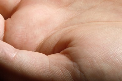 Photo of Closeup view of human hand with dry skin