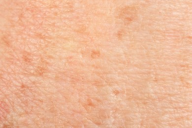 Photo of Texture of skin with pigmentation as background, macro view
