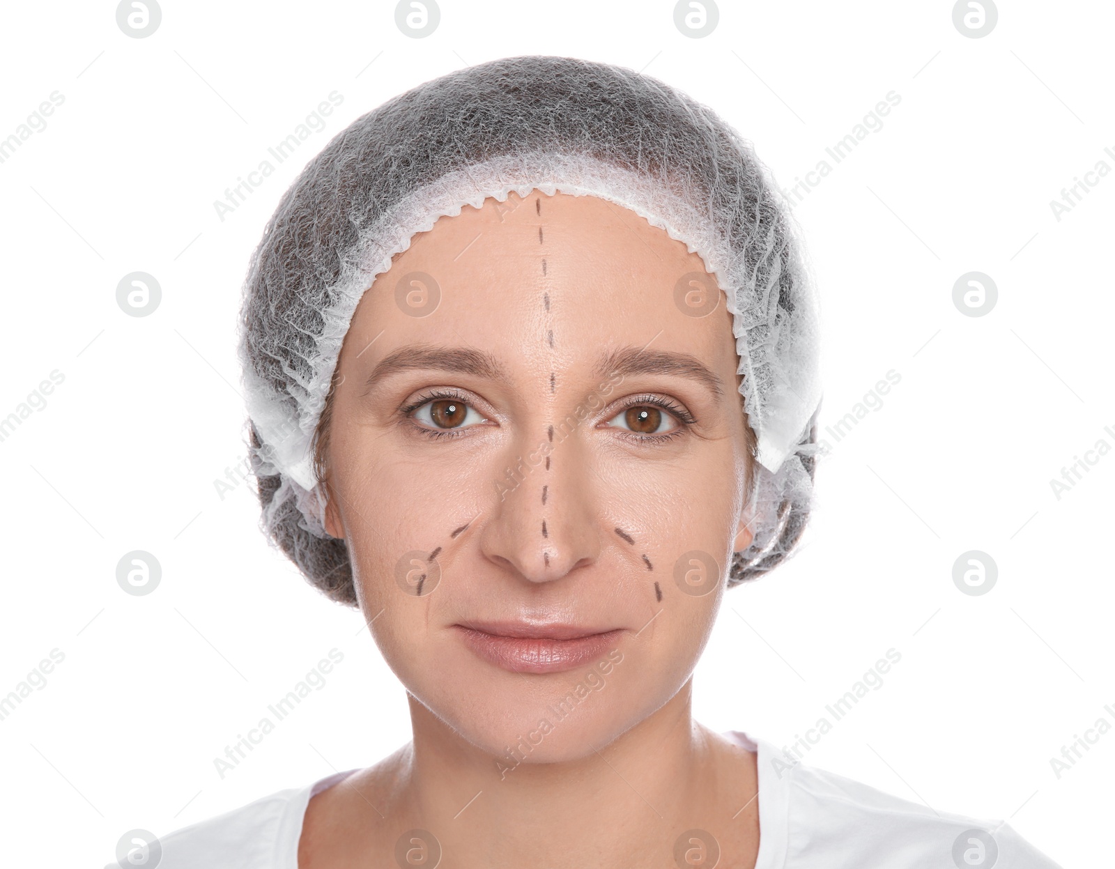 Photo of Portrait of woman with marks on face preparing for cosmetic surgery against white background