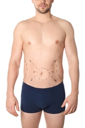 Man with marks on belly for cosmetic surgery operation against white background, closeup