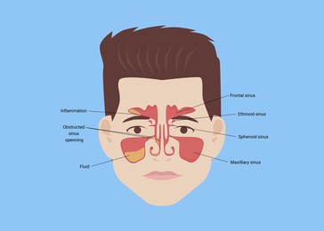 Illustration of  man with healthy and inflammed paranasal sinuses on light blue background