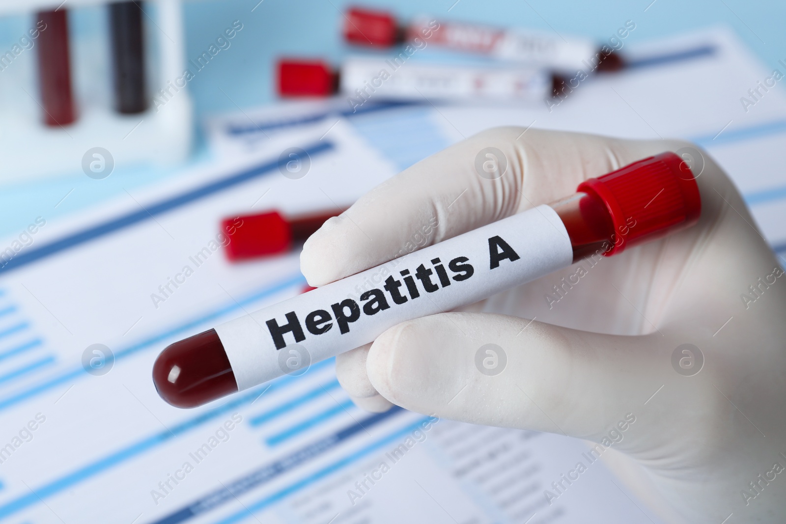 Photo of Scientist holding tube with blood sample and label Hepatitis A near laboratory test form, closeup