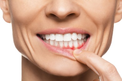 Woman showing inflamed gum on white background, closeup