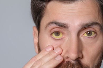 Photo of Man with yellow eyes on grey background, closeup. Symptom of hepatitis