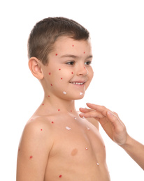 Woman applying cream onto skin of little boy with chickenpox on white background