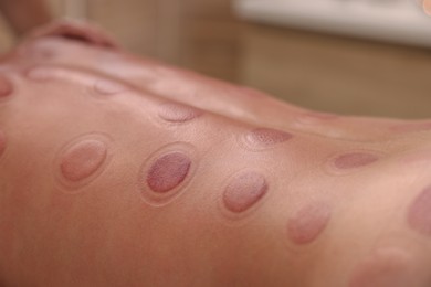 Closeup view of man after cupping therapy indoors