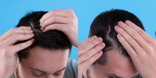 Man showing hair before and after dandruff treatment on light blue background, collage