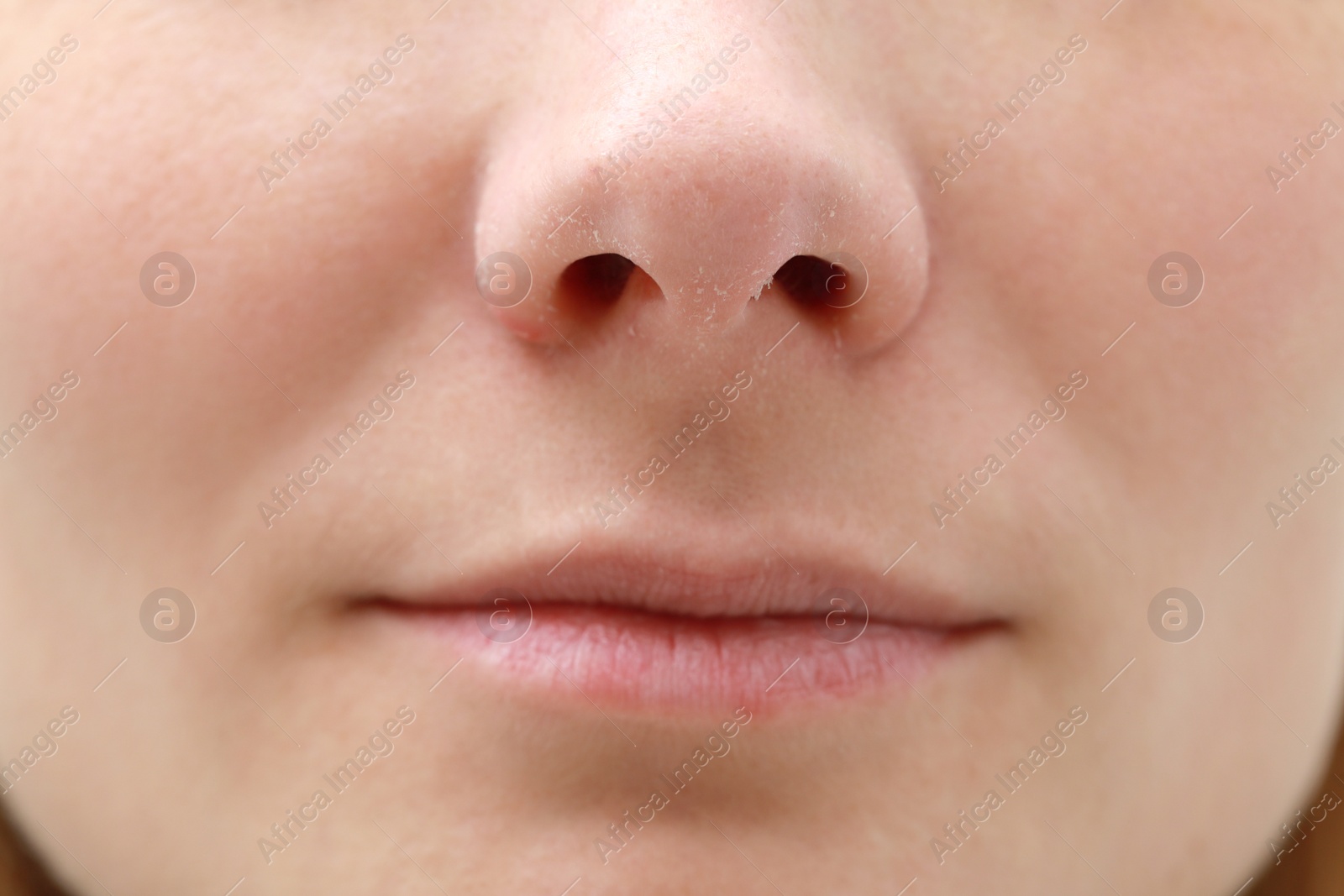 Photo of Woman with dry skin, closeup of mouth