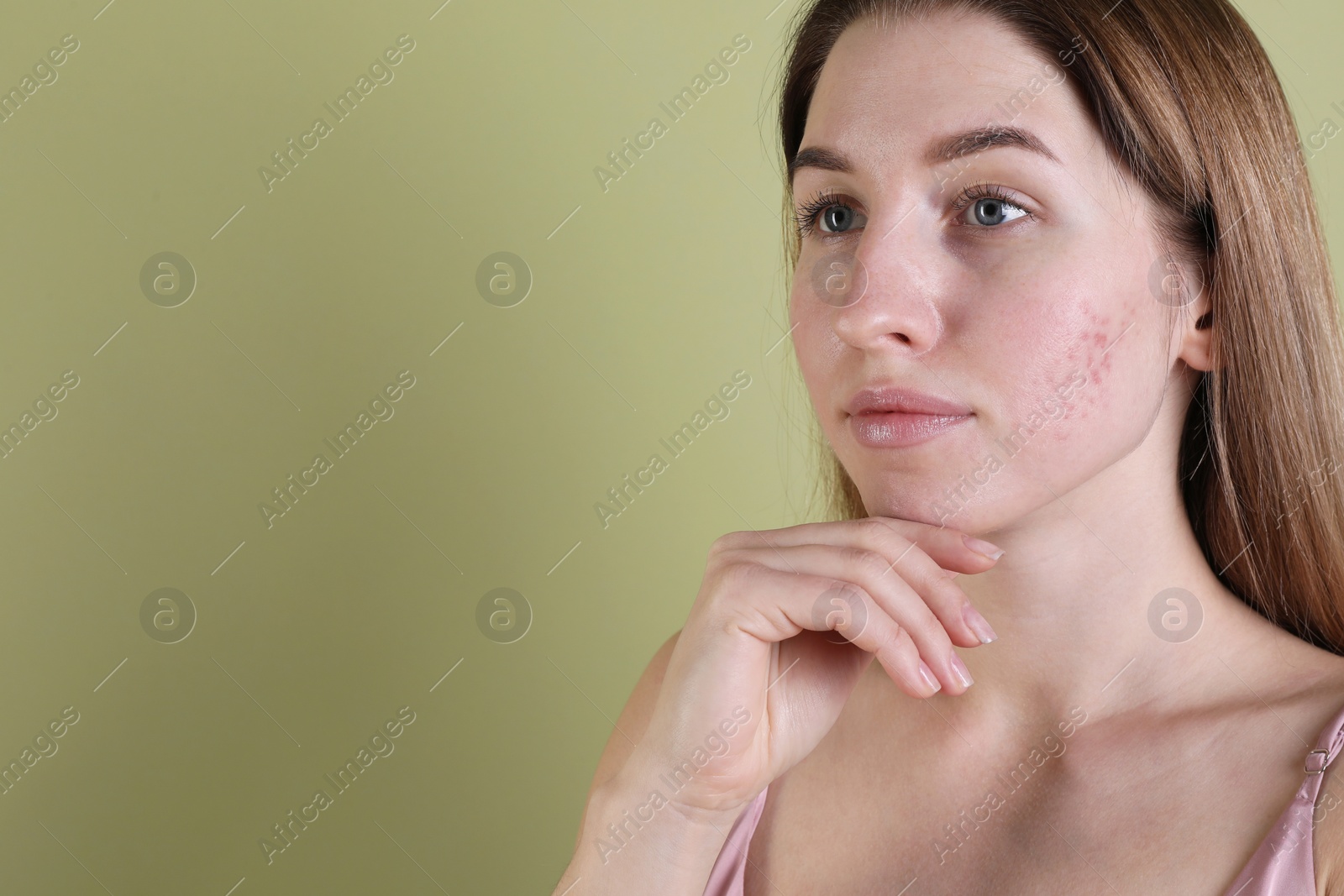 Photo of Young woman with acne problem on olive background. Space for text