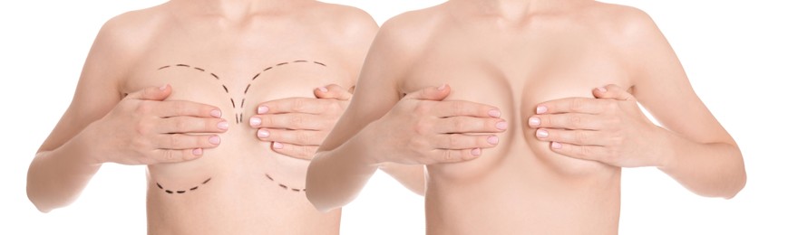 Image of Breast augmentation surgery. Photos of woman before with marks on skin and after with silicone implants, closeup. Collage design on white background