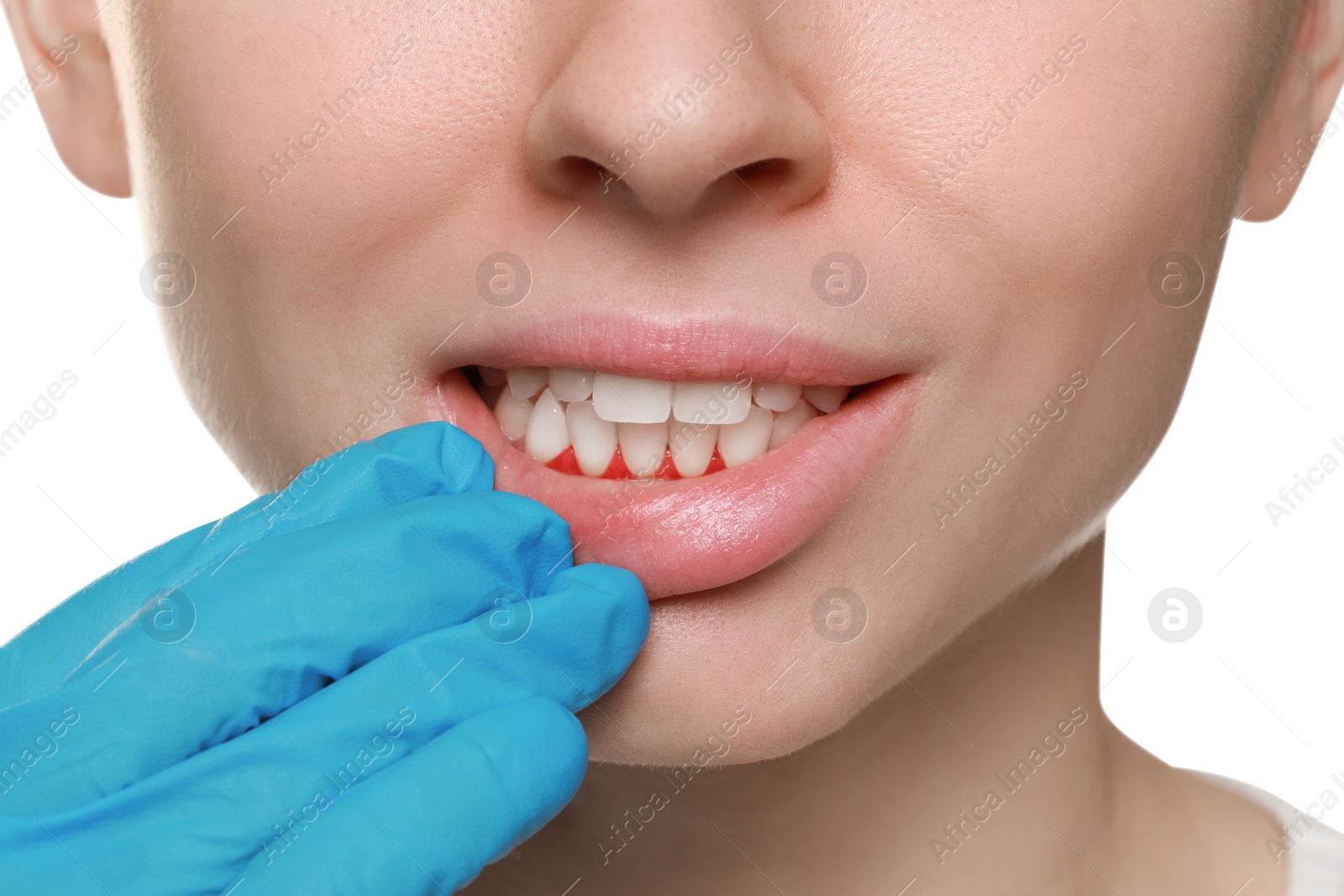 Image of Doctor examining woman's inflamed gum on white background, closeup