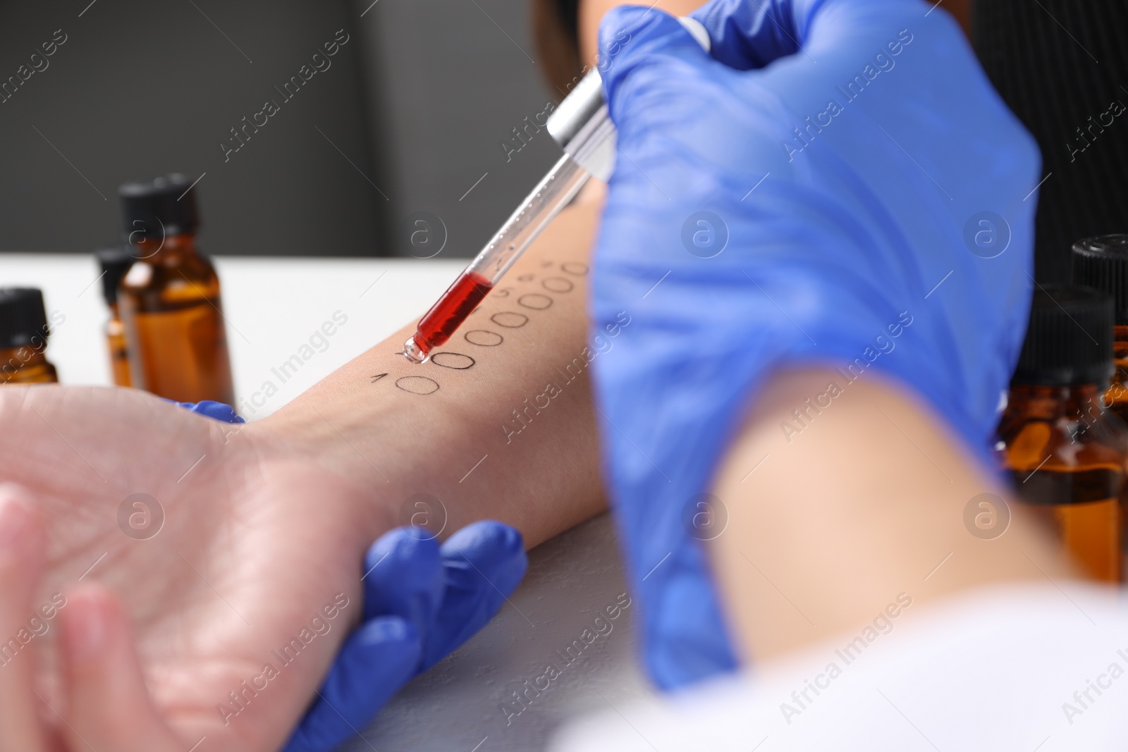 Photo of Doctor doing skin allergy test at light table, closeup