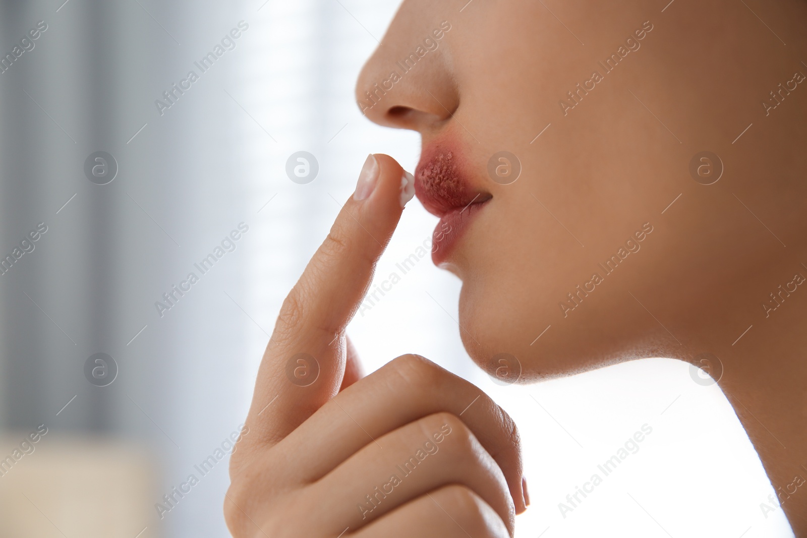 Photo of Woman with herpes applying cream on lips against blurred background, closeup