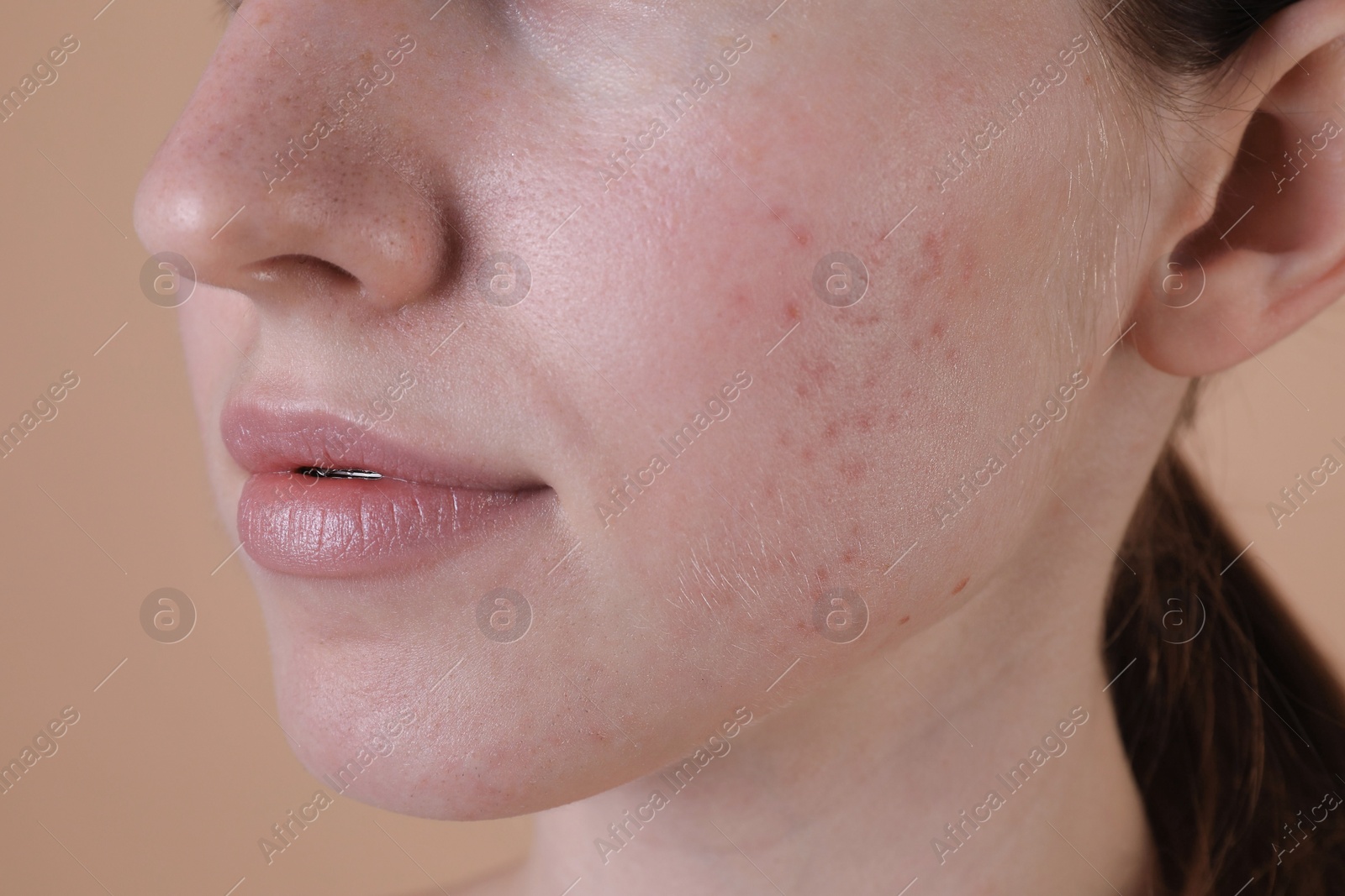 Photo of Young woman with acne problem on beige background, closeup