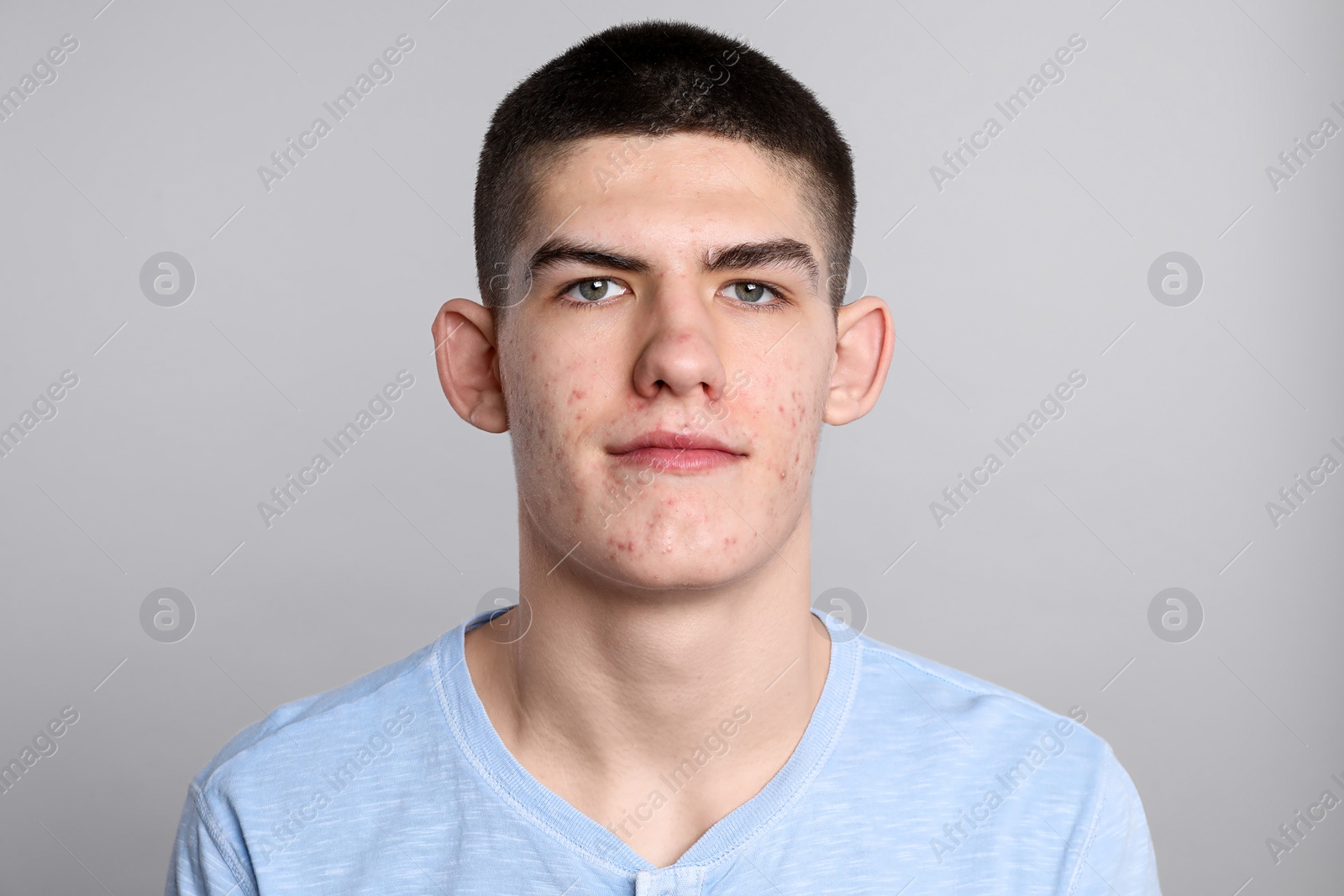 Photo of Young man with acne problem on grey background