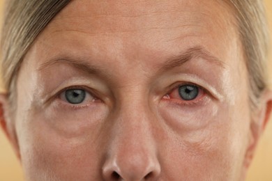 Image of Woman with red eye suffering from conjunctivitis, closeup