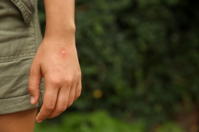 Photo of Woman with insect bites on arm in park, closeup. Space for text