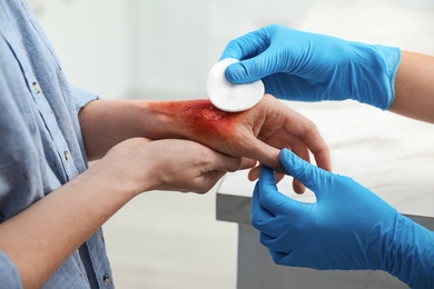 Doctor covering patient's burn of hand with cotton pad indoors, closeup