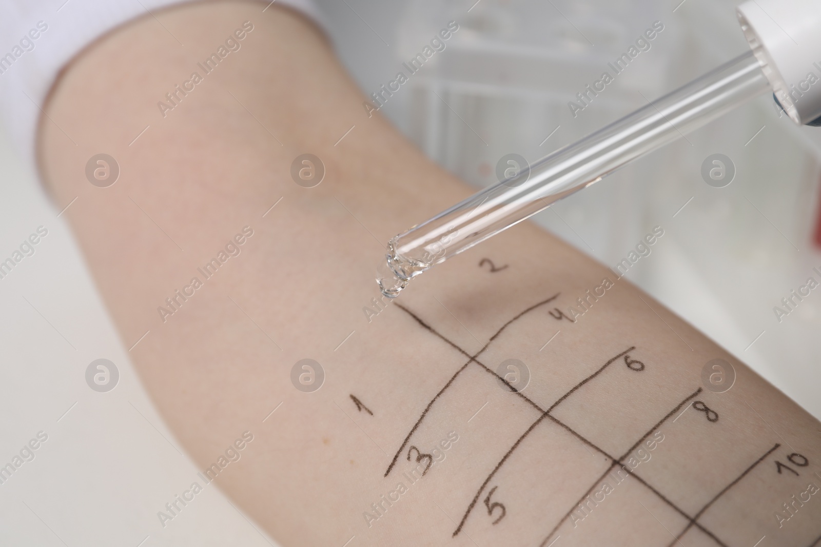 Photo of Patient undergoing skin allergy test at light table in clinic, closeup