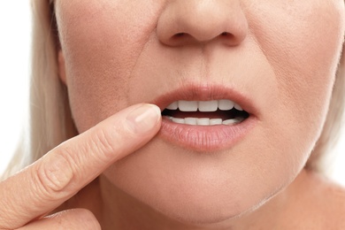 Image of Woman with cold sore applying cream on lips against white background, closeup