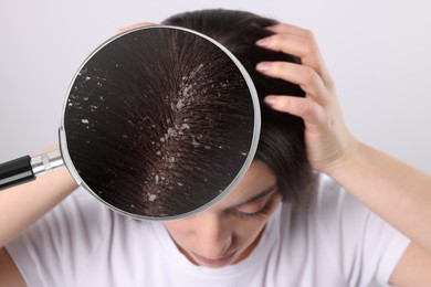 Image of Woman suffering from dandruff on light background. View through magnifying glass on hair with flakes