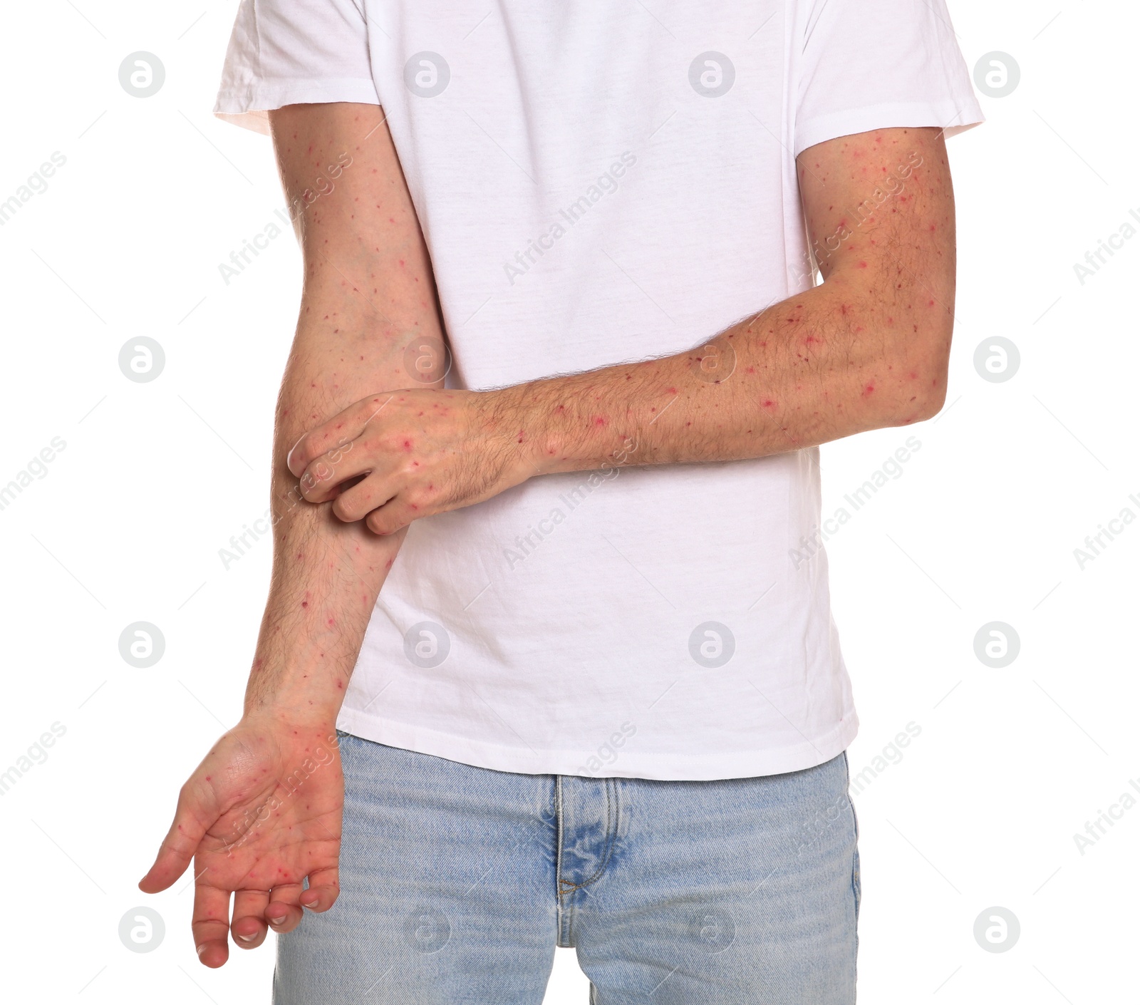 Photo of Man with rash suffering from monkeypox virus on white background, closeup