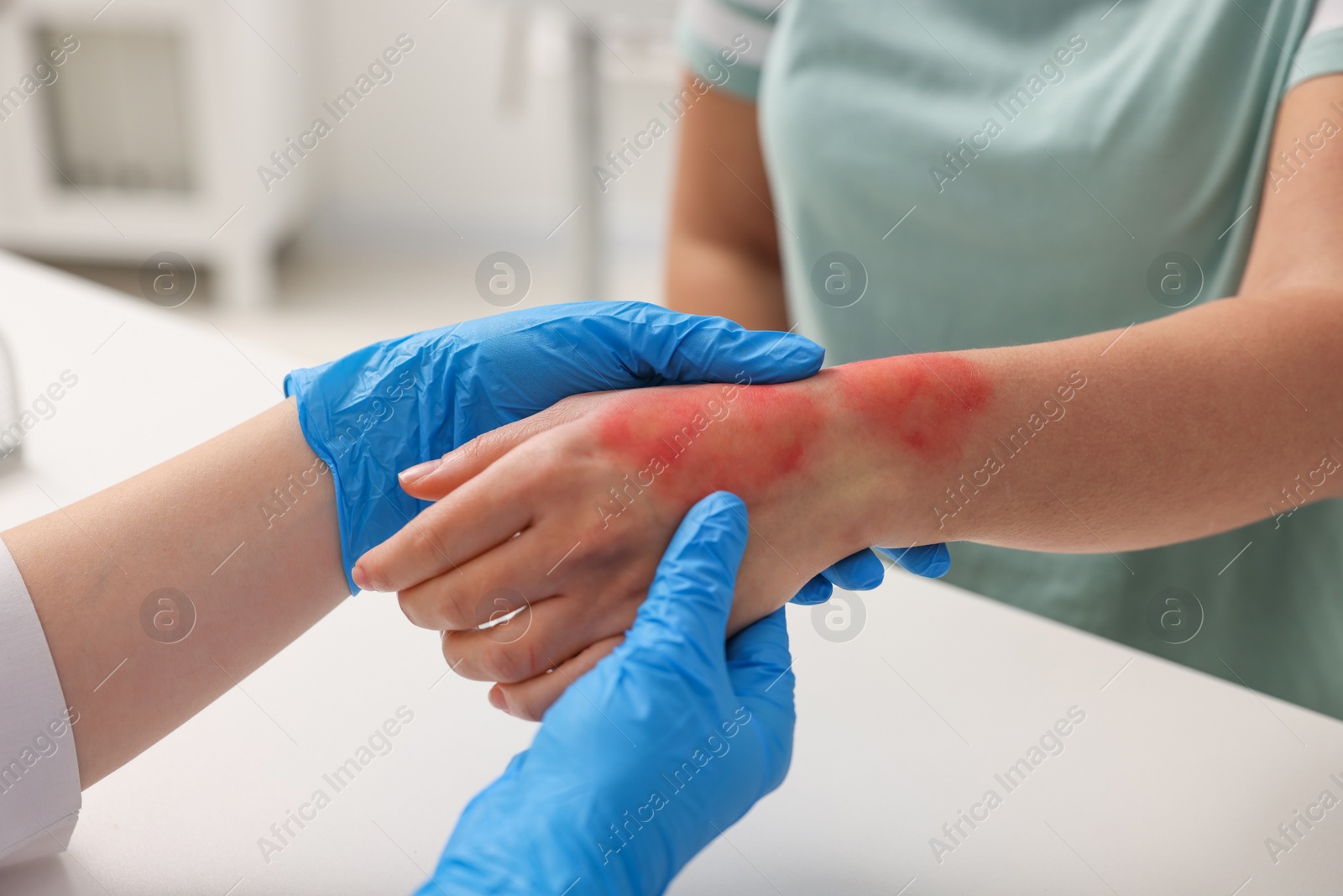 Photo of Doctor examining patient's burned hand indoors, closeup