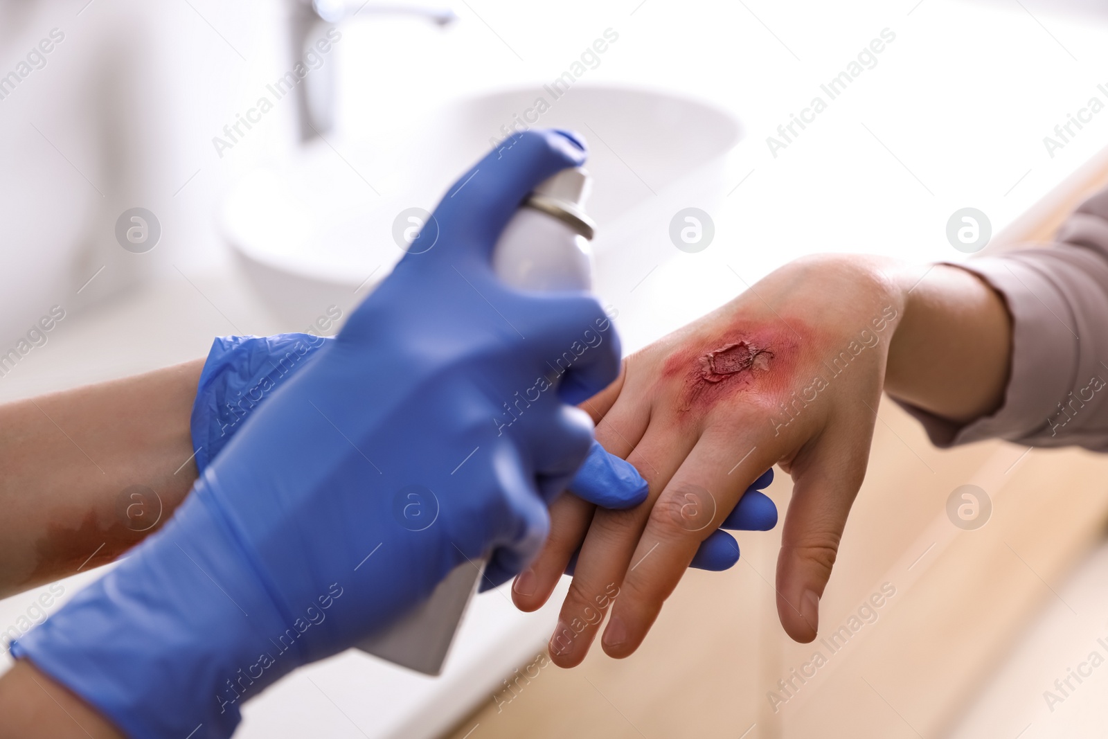 Photo of Applying burn spray onto injured skin, closeup